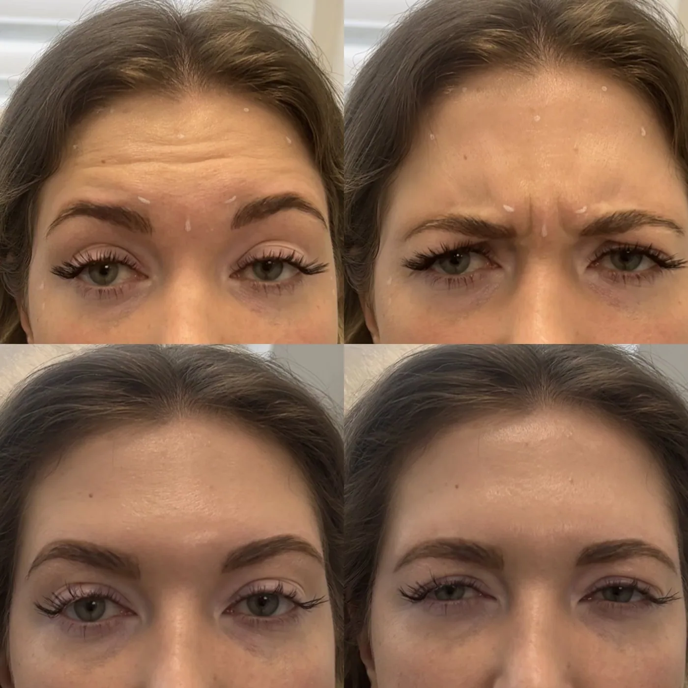 Ботулинотерапия лба и межбровья — до и после, Custom Clinic