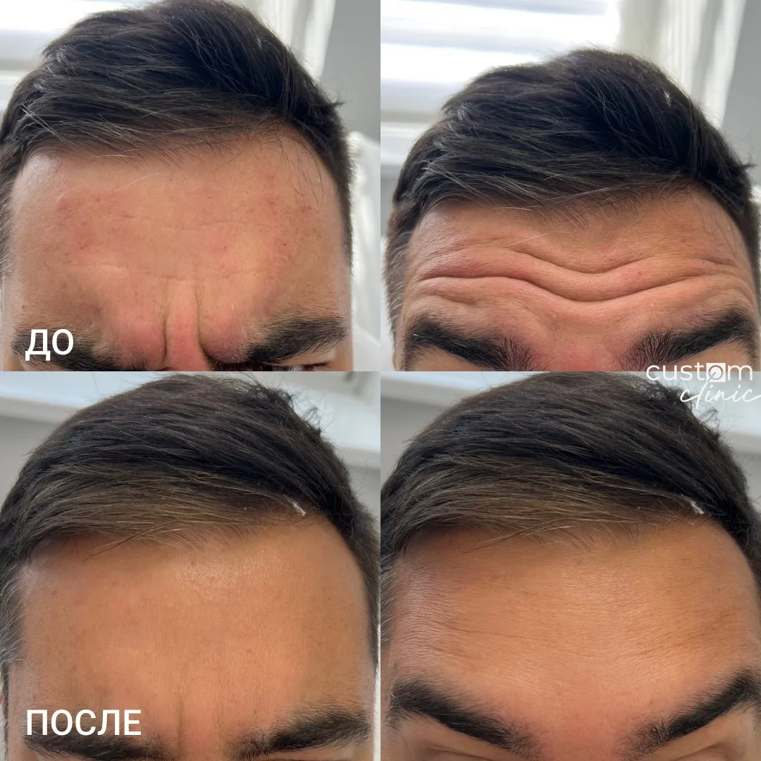 Ботулинотерапия у мужчины — до и после, Custom Clinic