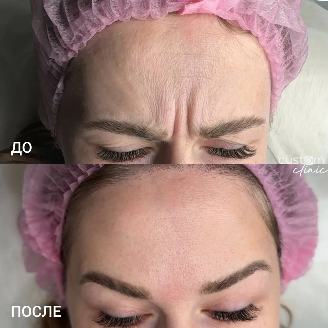 Ботулинотерапия межбровья — до и после, Custom Clinic