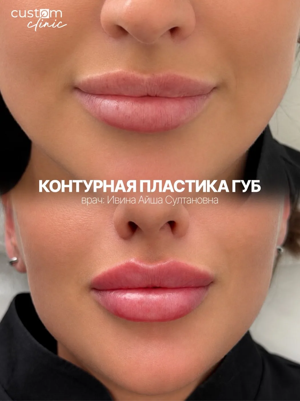 Контурная пластика губ — до и после, Custom Clinic Санкт-Петербург