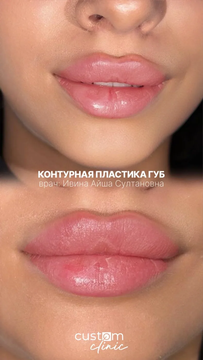 Контурная пластика губ — до и после, Custom Clinic Санкт-Петербург