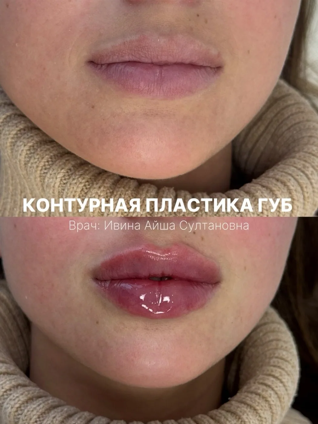 Контурная пластика губ — до и после, Custom Clinic Санкт-Петербург