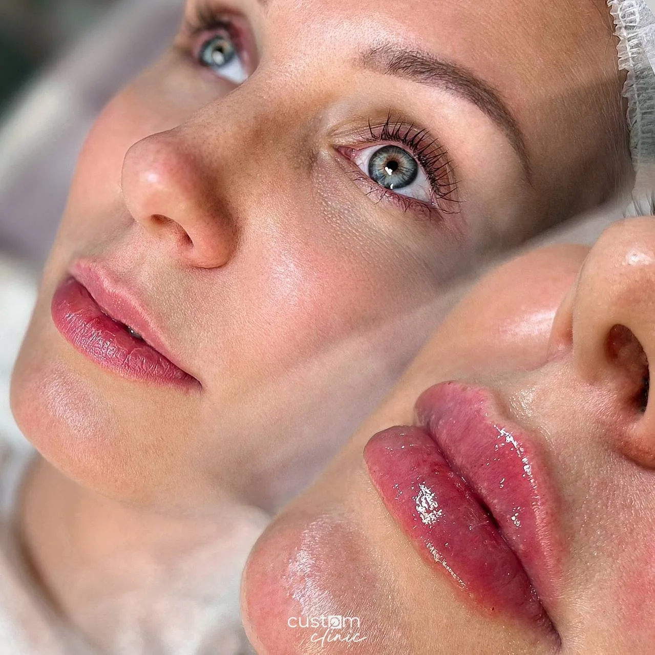Контурная пластика губ — до и после, Custom Clinic Санкт-Петербург