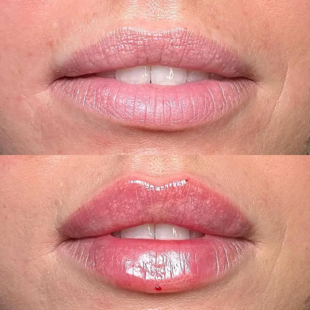 Контурная пластика губ — до и после, Custom Clinic Санкт-Петербург