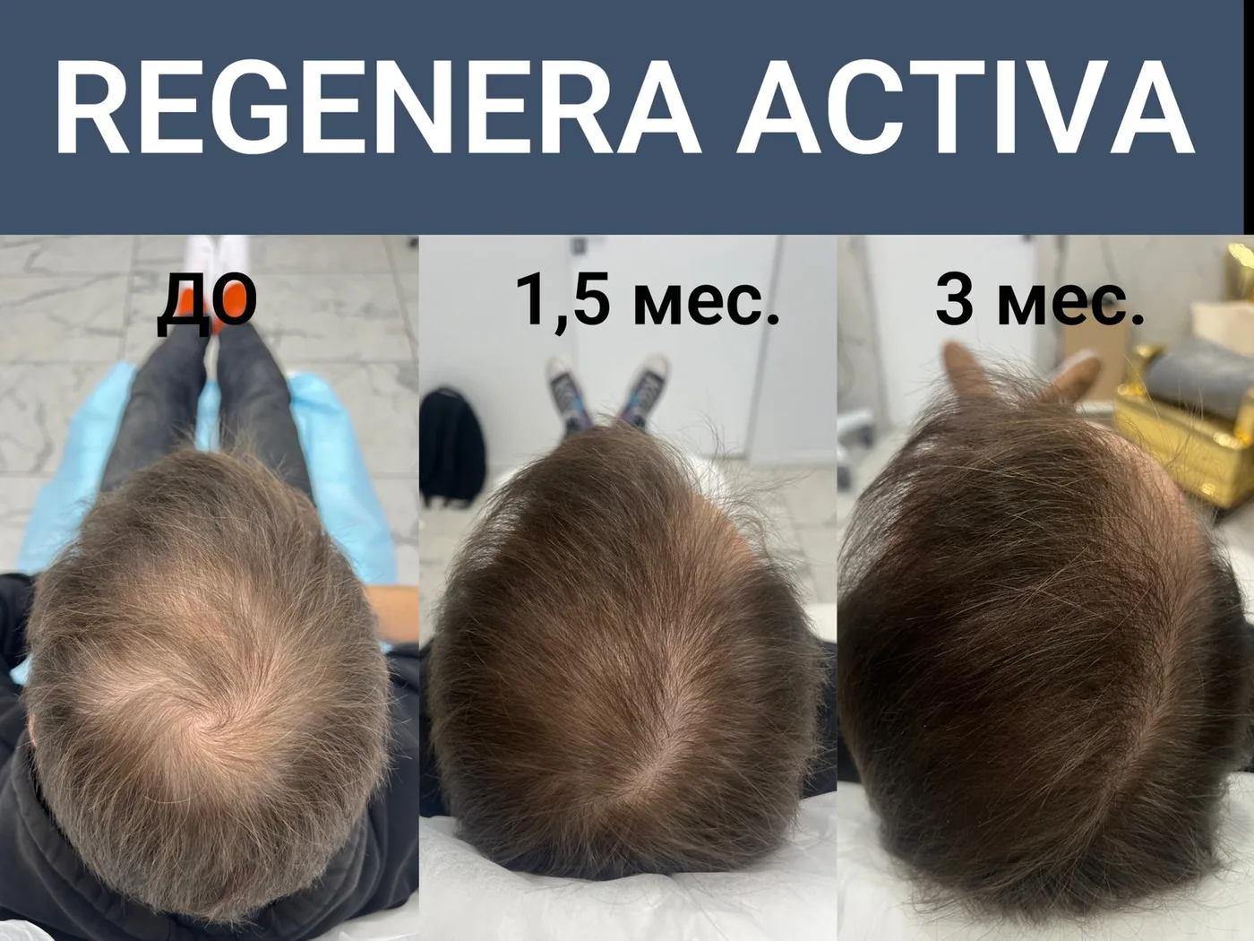 Regenera Activa: до, 1,5 и 3 месяца