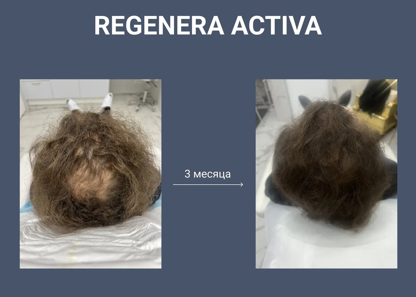 Regenera Activa: результат через 3 месяца