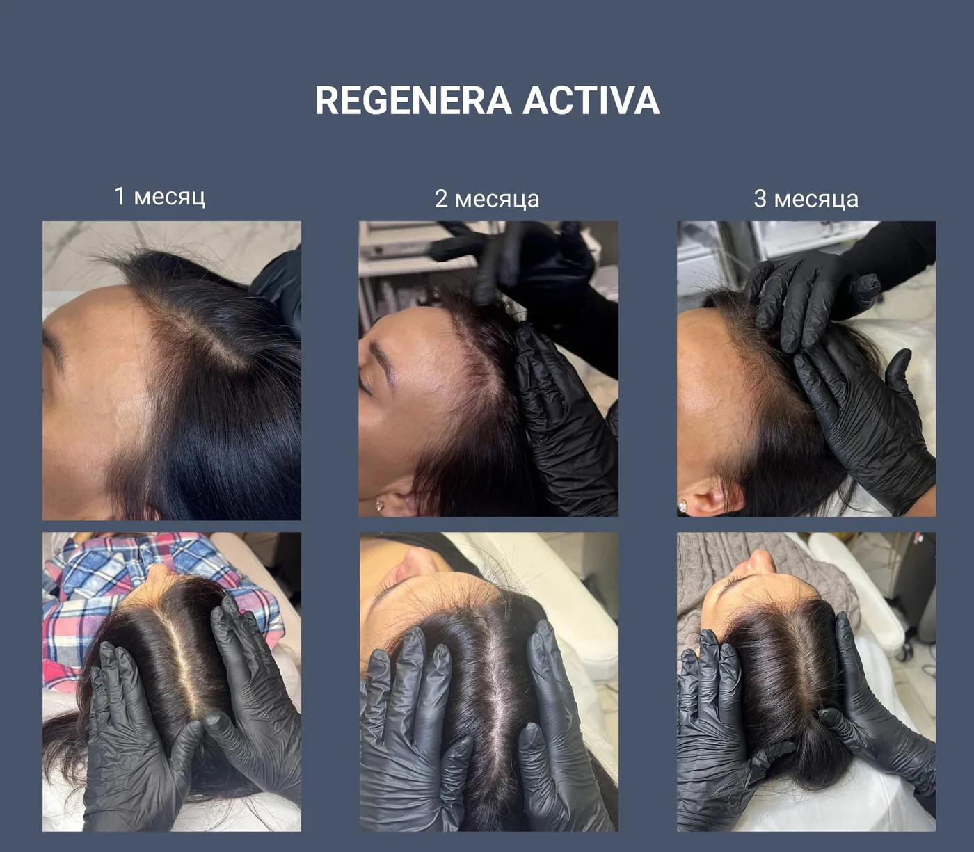 Regenera Activa: 1, 2 и 3 месяца
