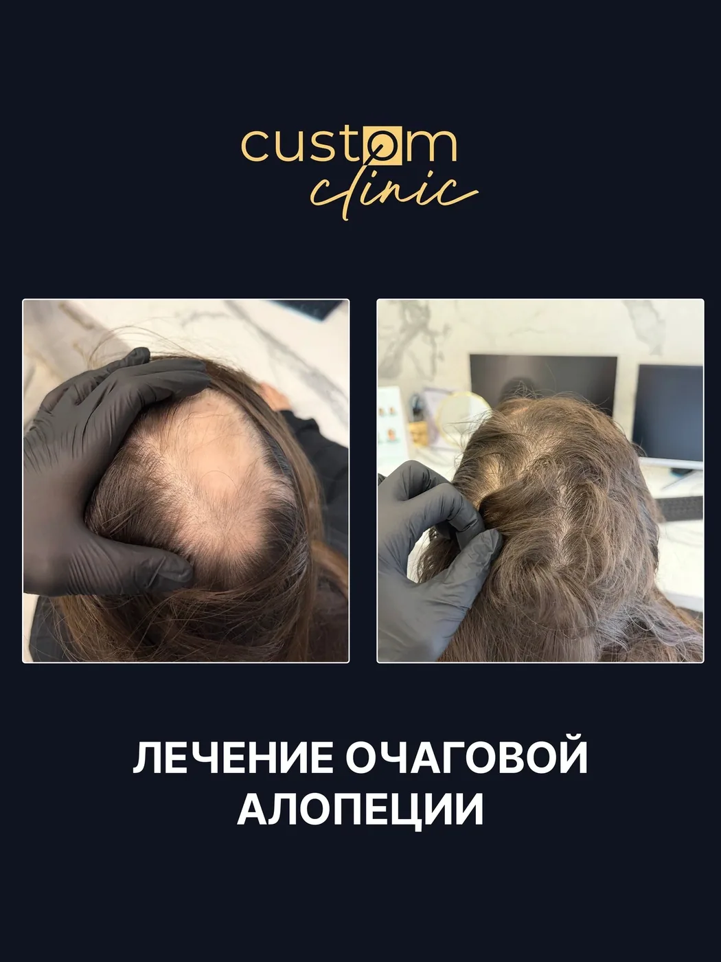 Лечение очаговой алопеции