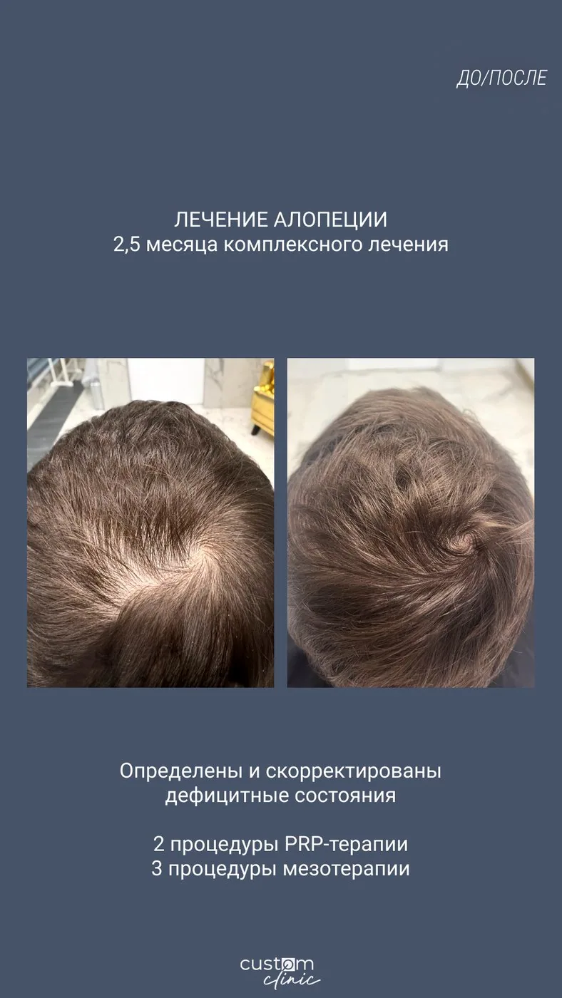 Лечение алопеции: 2,5 месяца курса PRP и мезотерапии