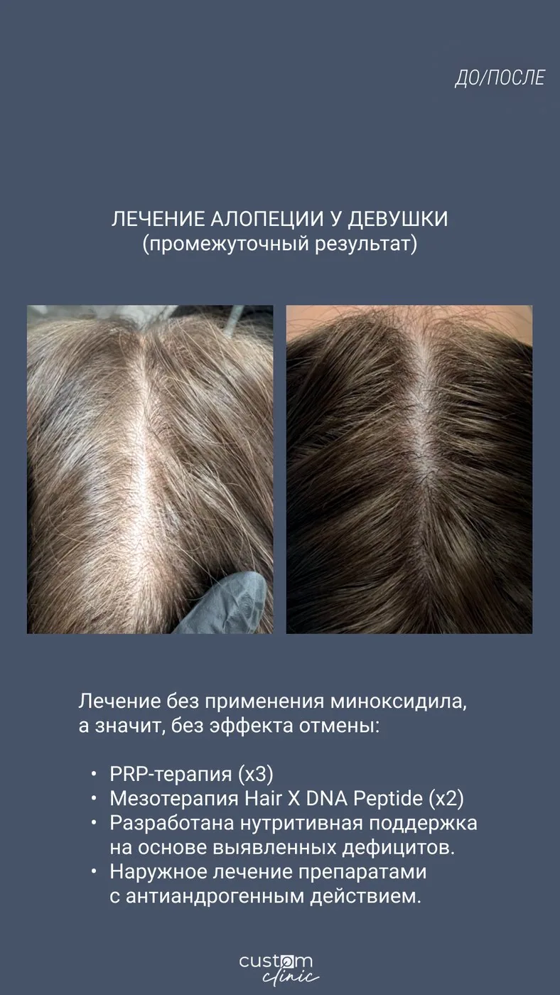 Лечение алопеции у девушки: промежуточный результат