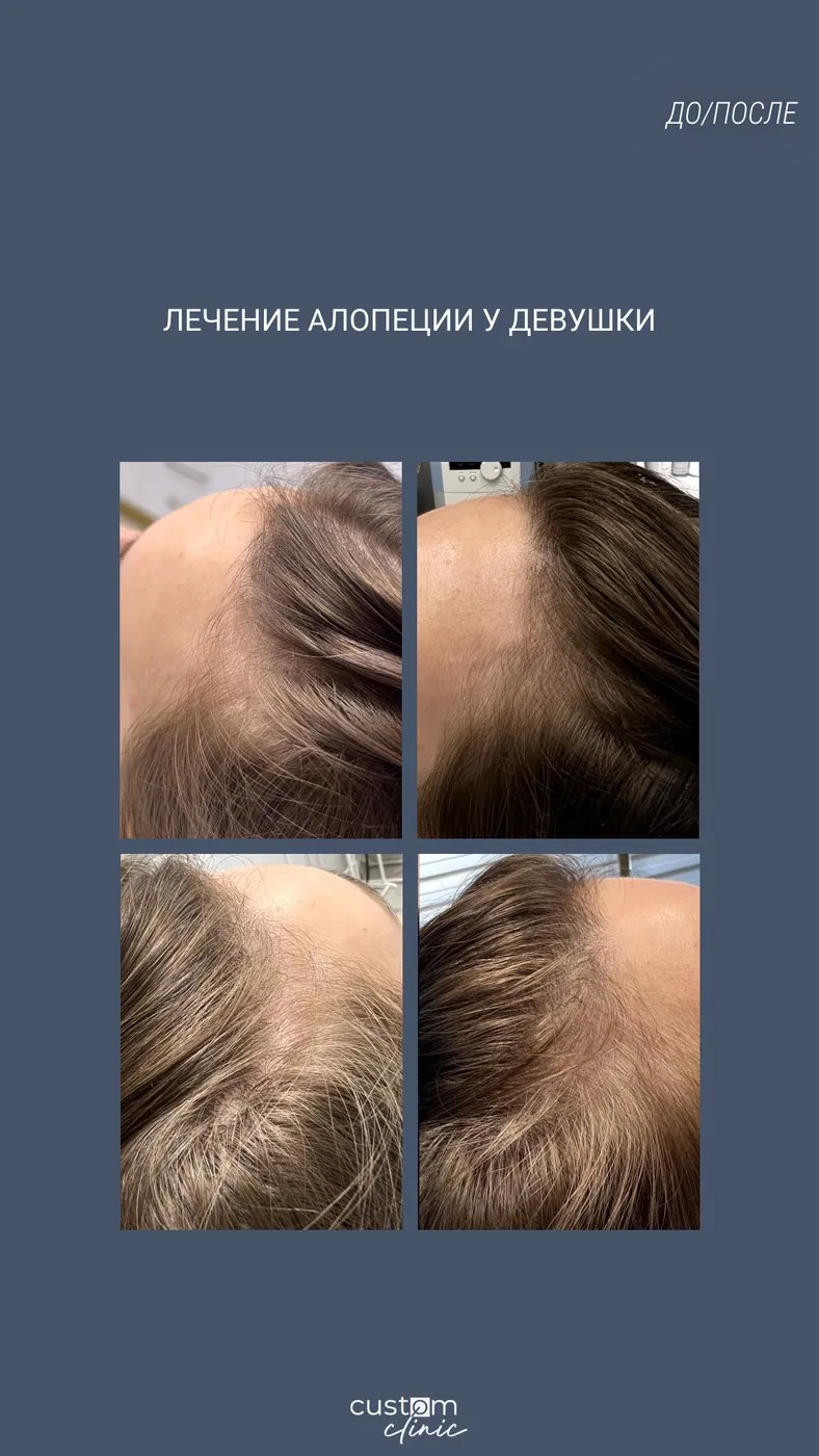 Лечение алопеции у девушки: до и после курса