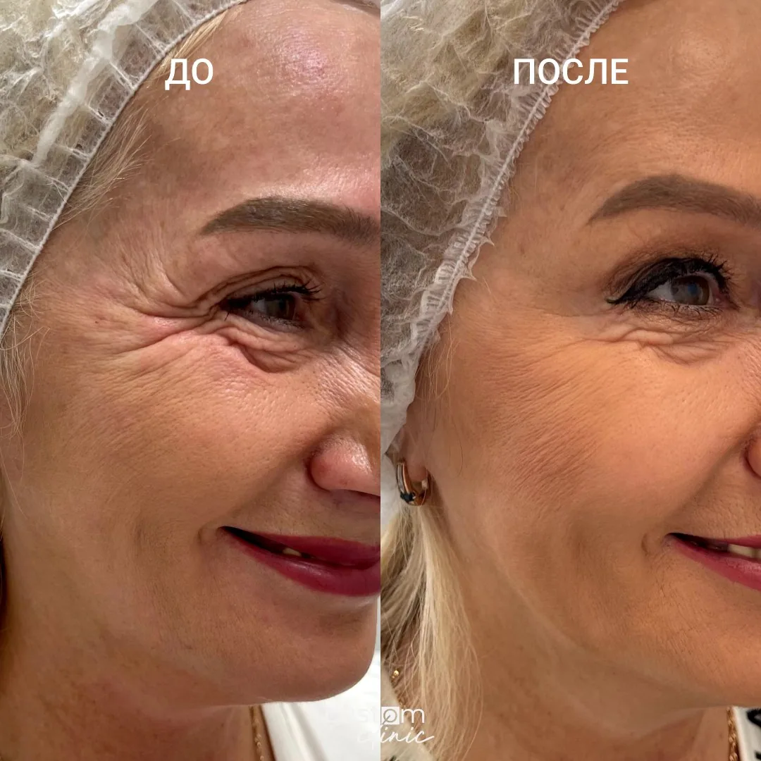 Работа с возрастными изменениями лица — до и после, Custom Clinic