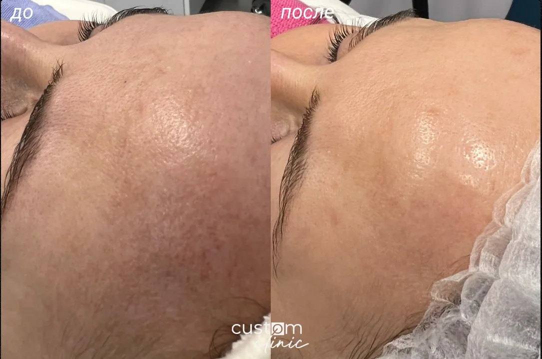 Кожа лба до и после процедуры — Custom Clinic