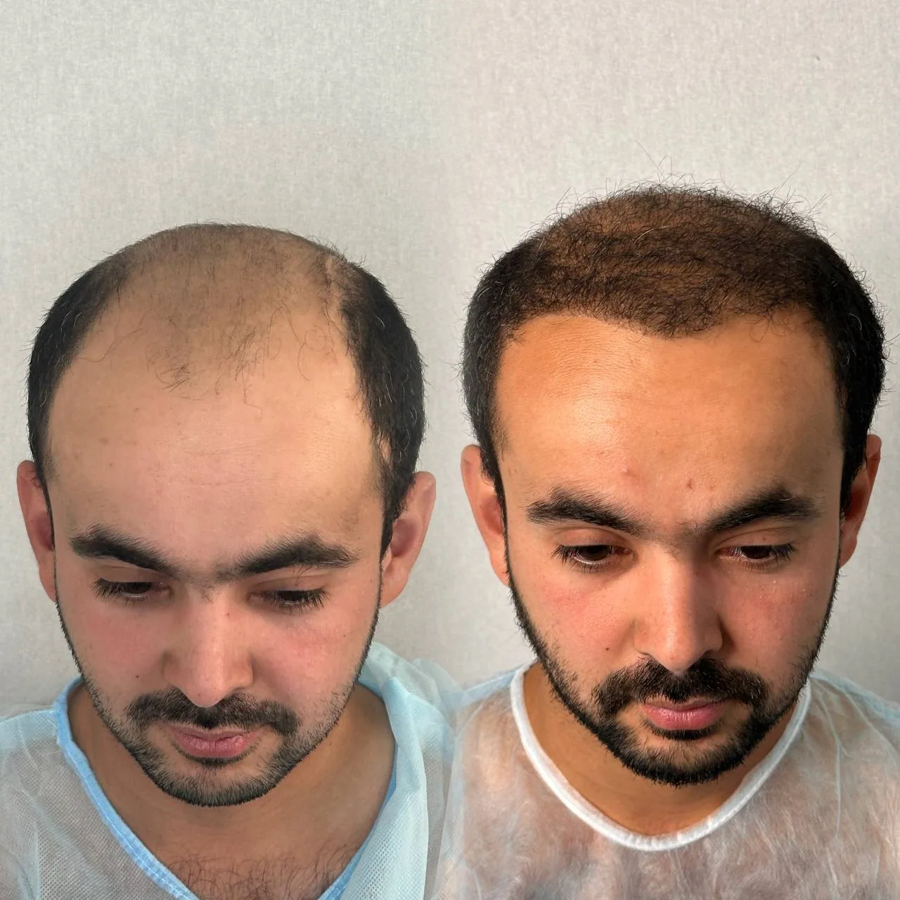 Пересадка волос — до и после, Custom Clinic Санкт-Петербург