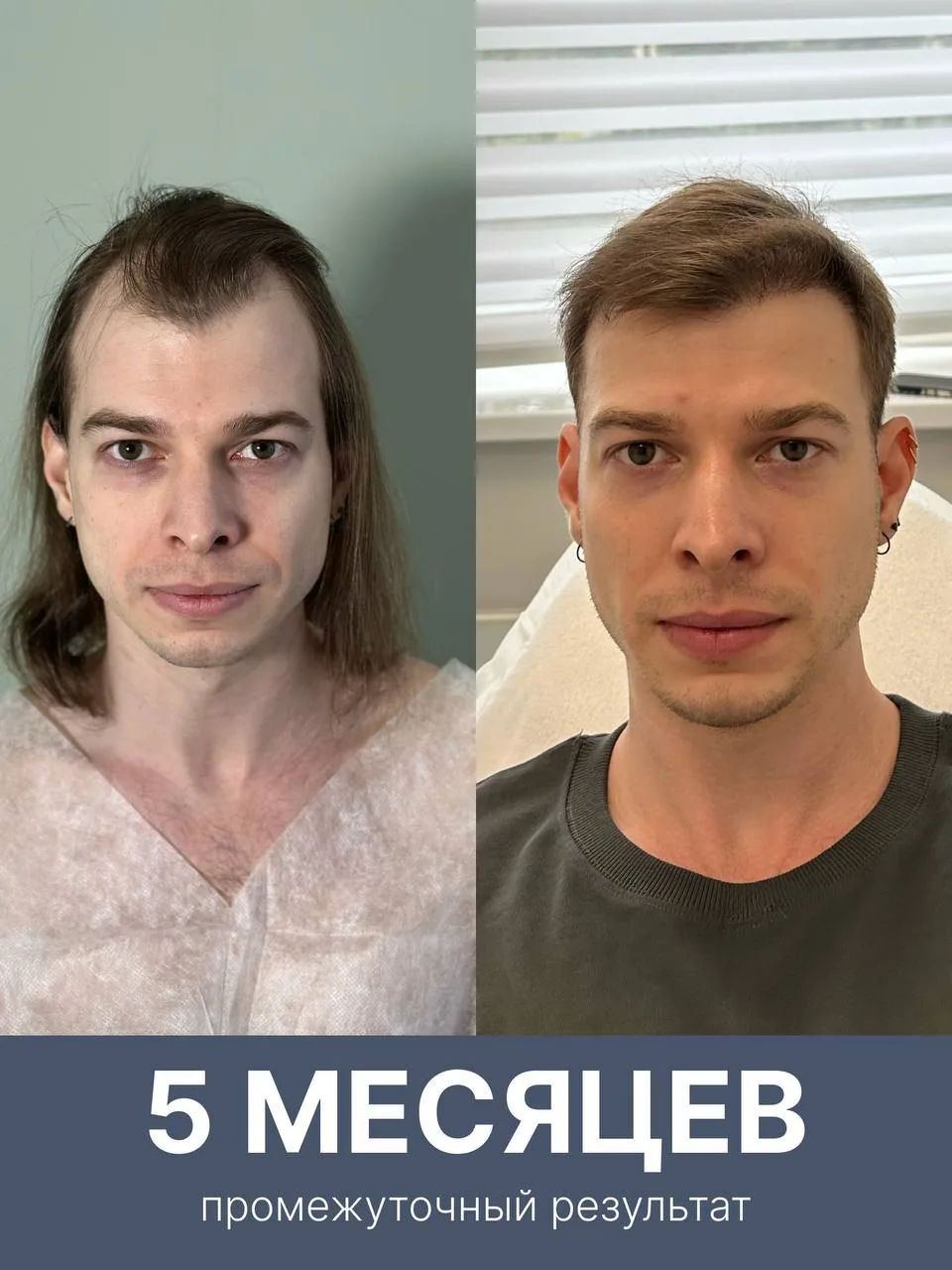 Пересадка волос: промежуточный результат через 5 месяцев — Custom Clinic