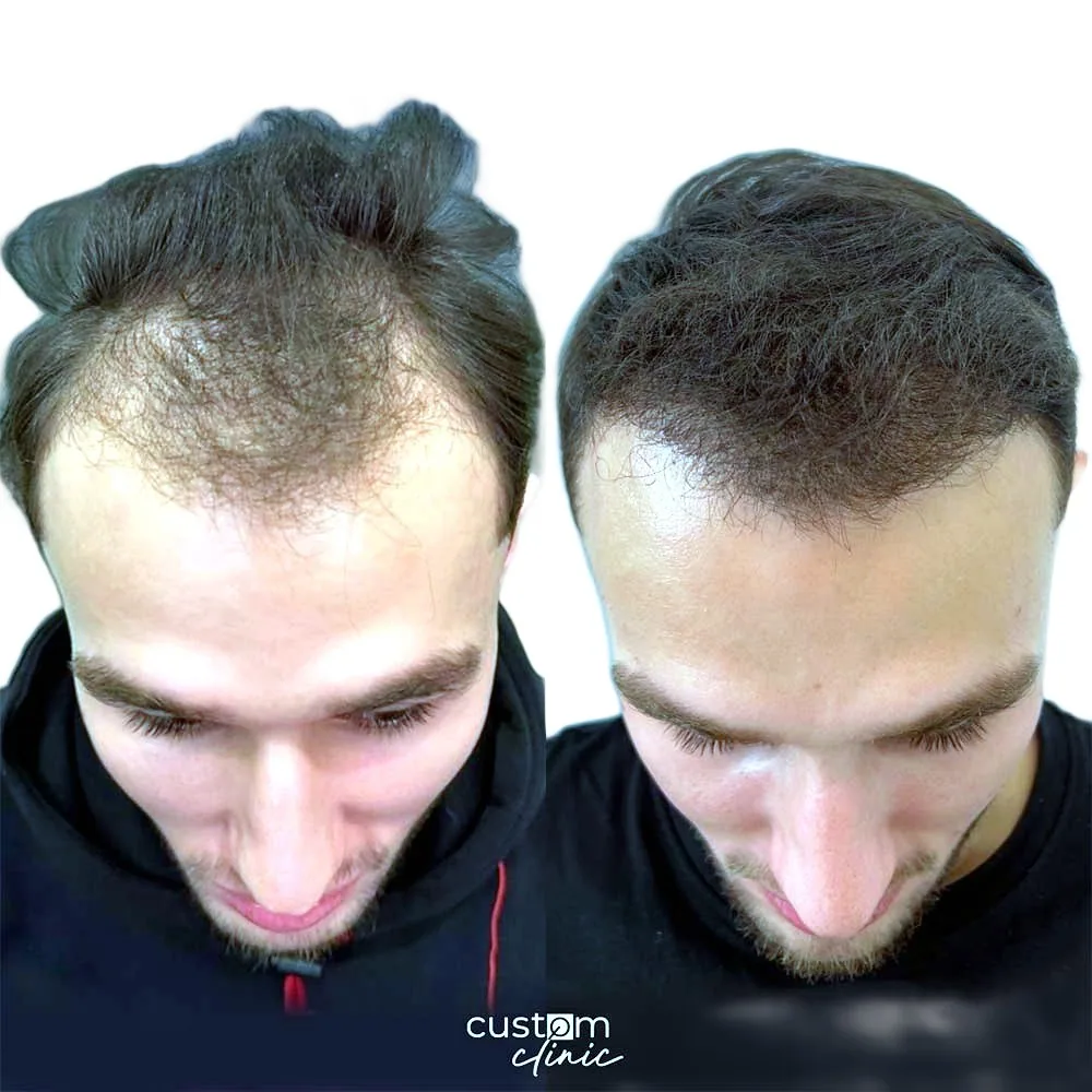 Пересадка волос, работа 14: до и после, спустя 8 месяцев после пересадки — Custom Clinic, Санкт-Петербург