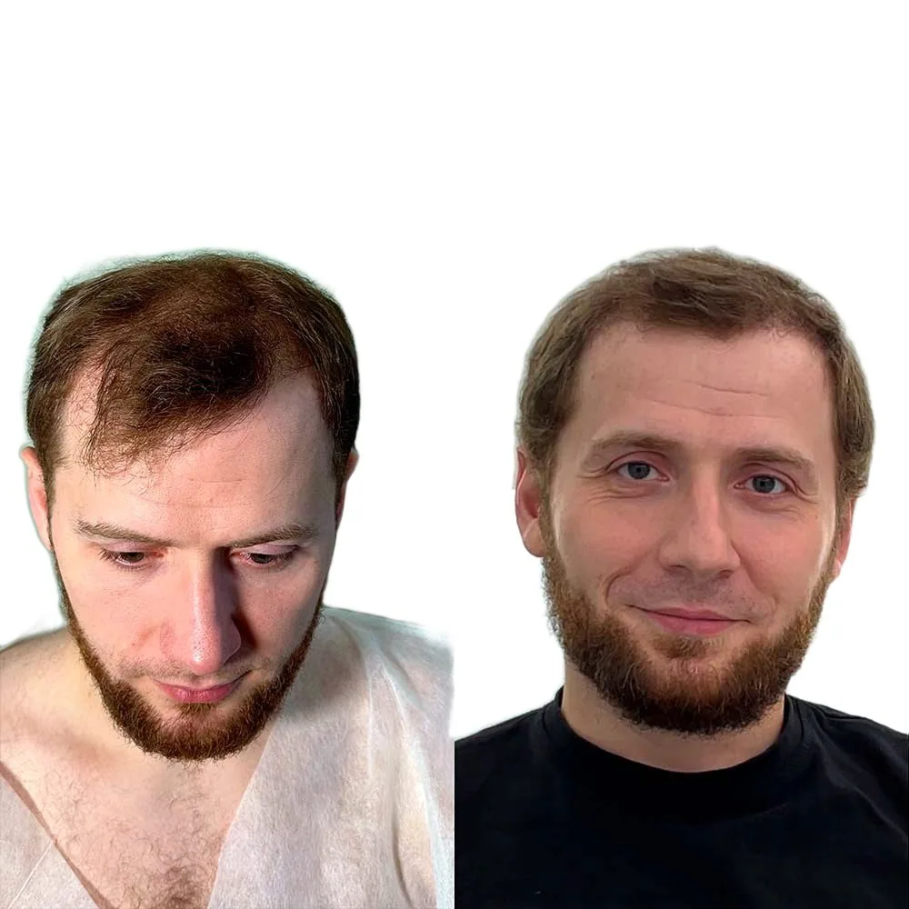Пересадка волос, работа 15: до и после, спустя 7,5 месяца после пересадки — Custom Clinic, Санкт-Петербург