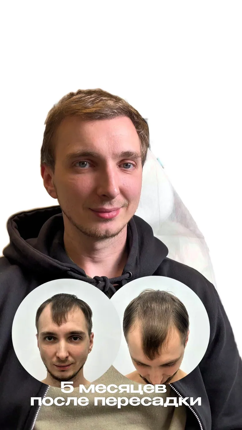 Пересадка волос, работа 21: до и после, результат пересадки — Custom Clinic, Санкт-Петербург