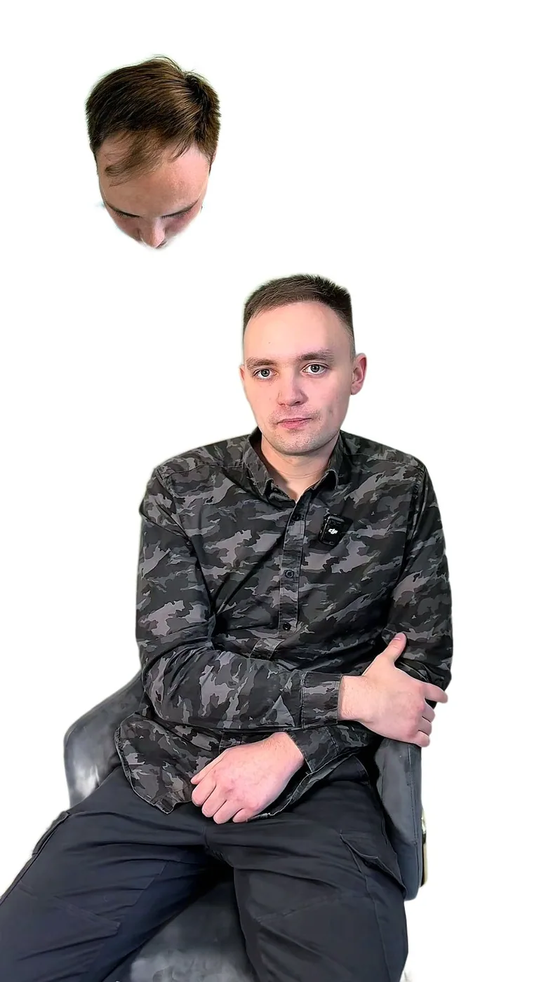 Пересадка волос, работа 22: до и после, результат пересадки — Custom Clinic, Санкт-Петербург
