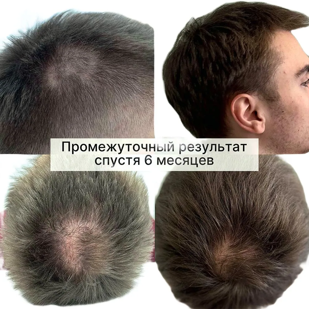 Пересадка волос, работа 23: до и после, результат пересадки — Custom Clinic, Санкт-Петербург