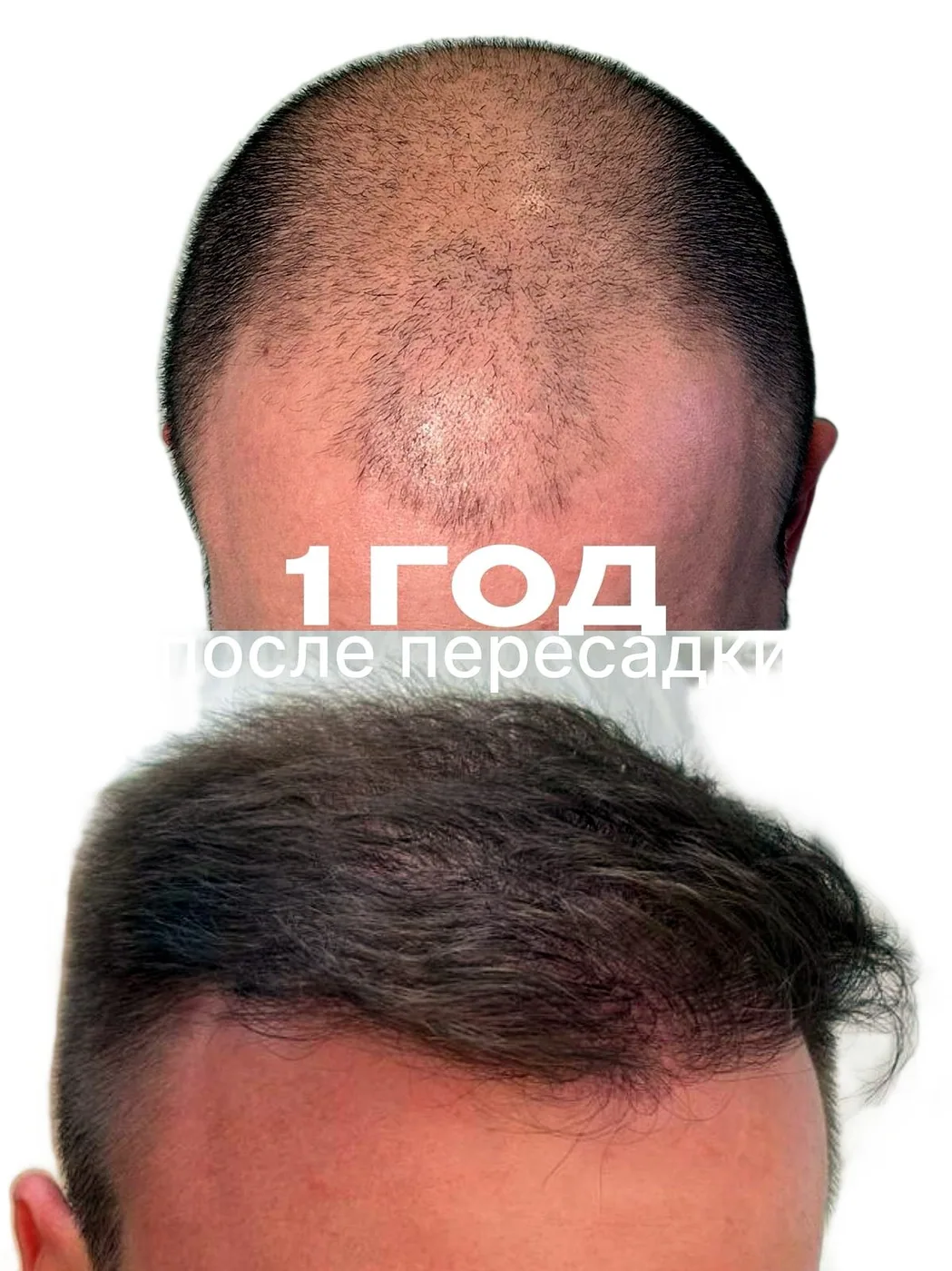 Пересадка волос, работа 16: до и после, 8 месяцев после пересадки — Custom Clinic, Санкт-Петербург