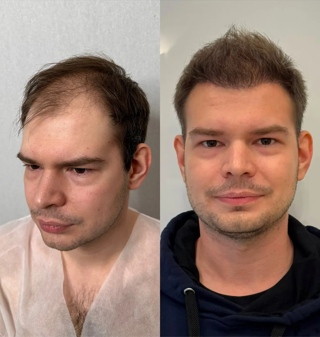 Пересадка волос, работа 8: до и после, спустя 8 месяцев после пересадки — Custom Clinic, Санкт-Петербург
