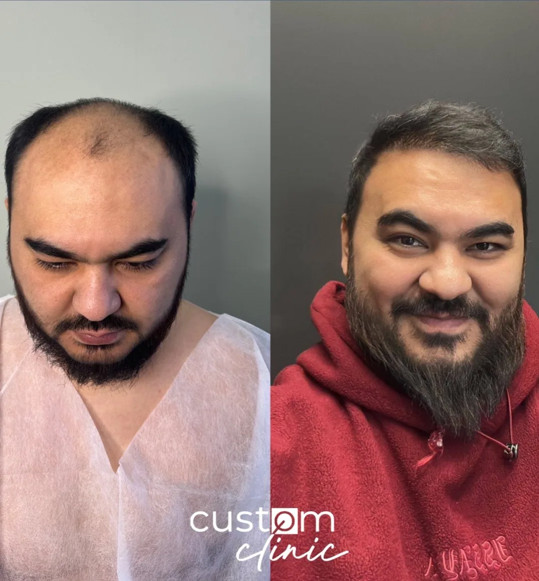 Пересадка волос, работа 9: до и после, спустя 8 месяцев после пересадки — Custom Clinic, Санкт-Петербург