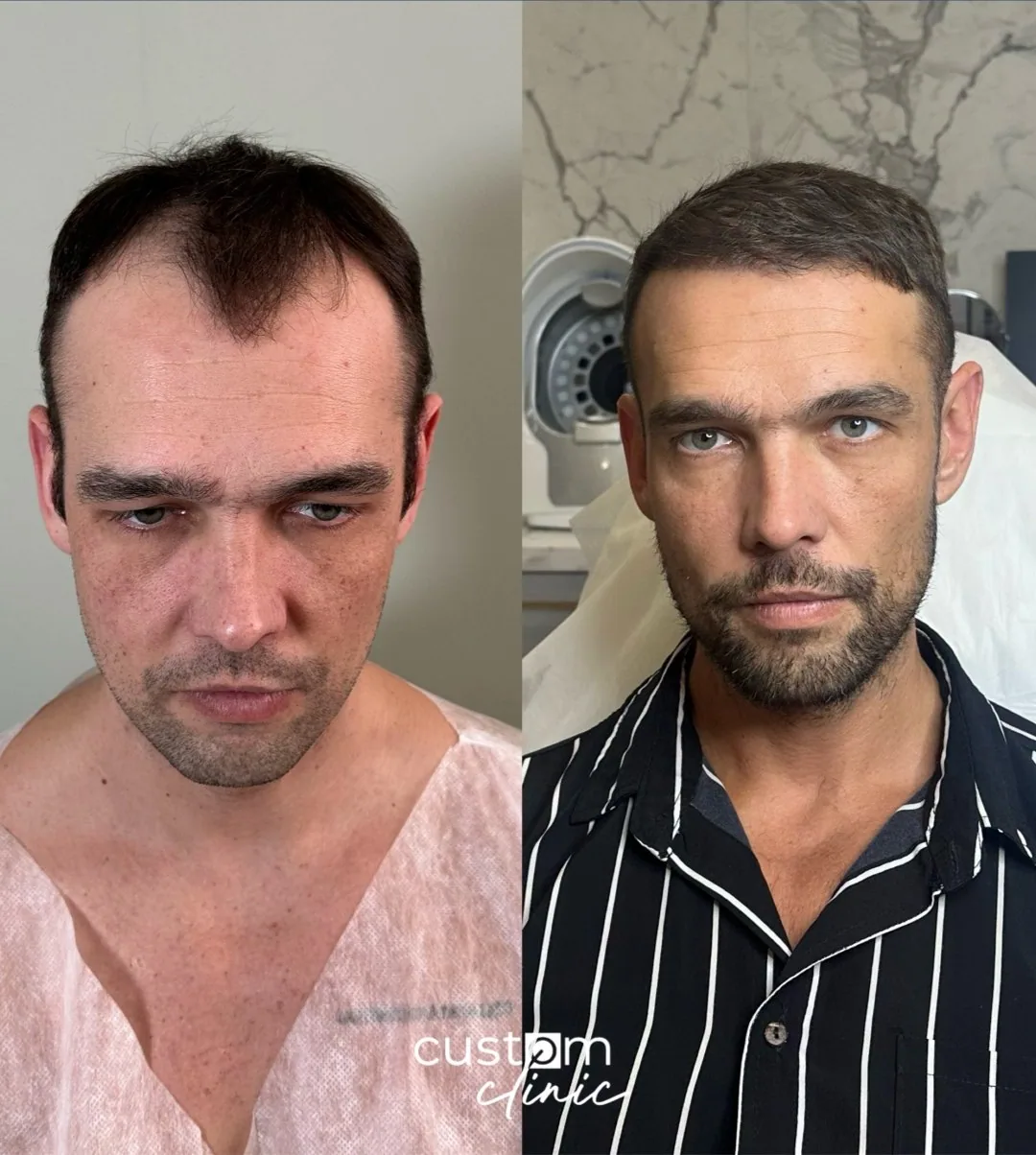 Пересадка волос, работа 10: до и после, спустя 9 месяцев после пересадки — Custom Clinic, Санкт-Петербург