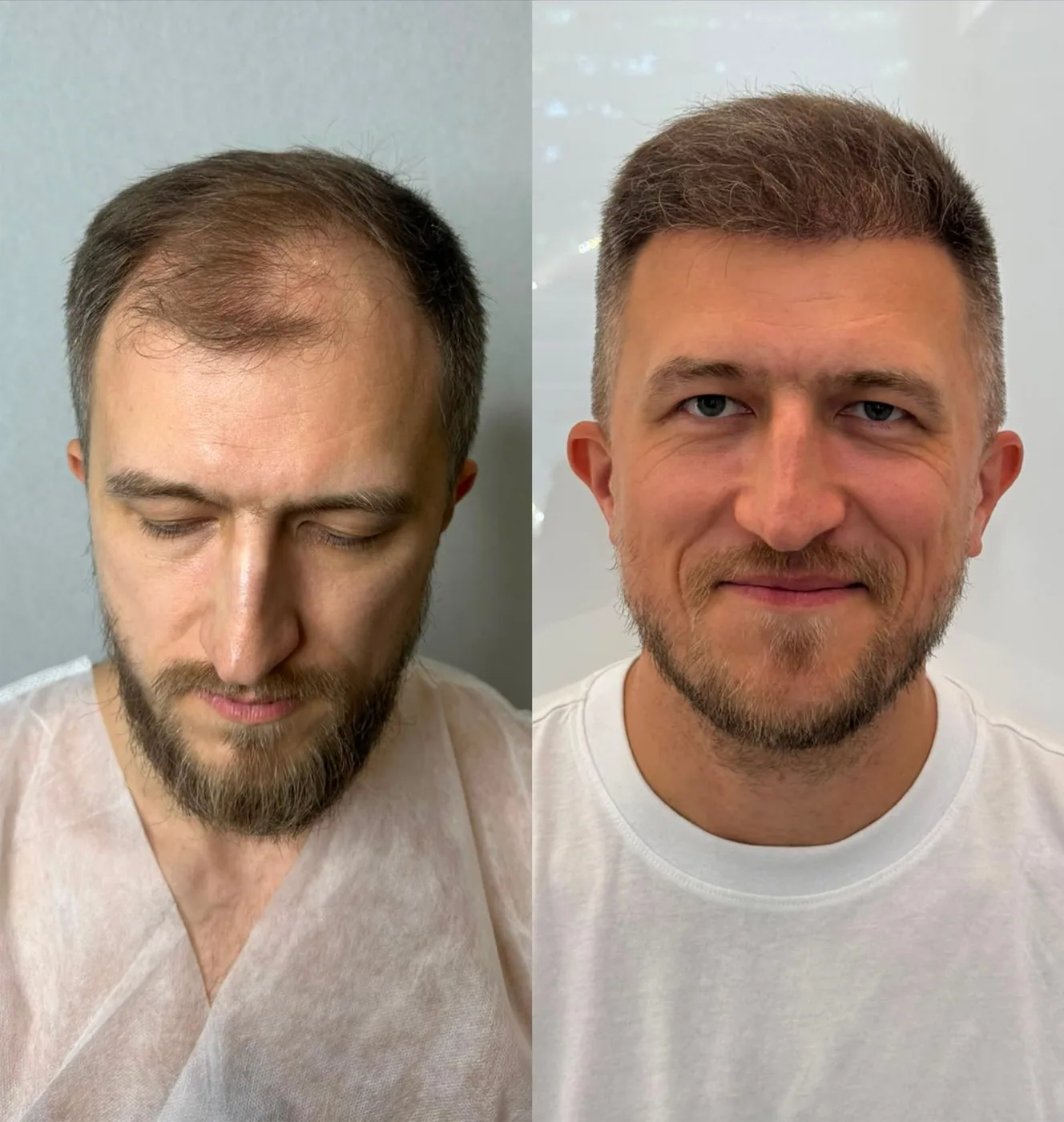 Пересадка волос, работа 1: до и после, спустя 6 месяцев после пересадки — Custom Clinic, Санкт-Петербург