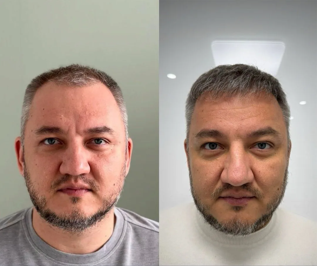 Пересадка волос, работа 2: до и после, спустя 6 месяцев после пересадки — Custom Clinic, Санкт-Петербург